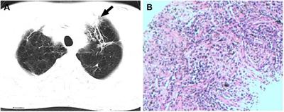 Case Report: two cases of anti-neutrophil cytoplasmic antibody-associated vasculitis involving large vessels
